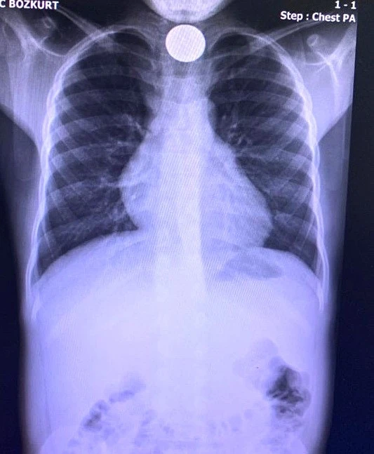 Madeni para yutan çocuk ölümden döndü