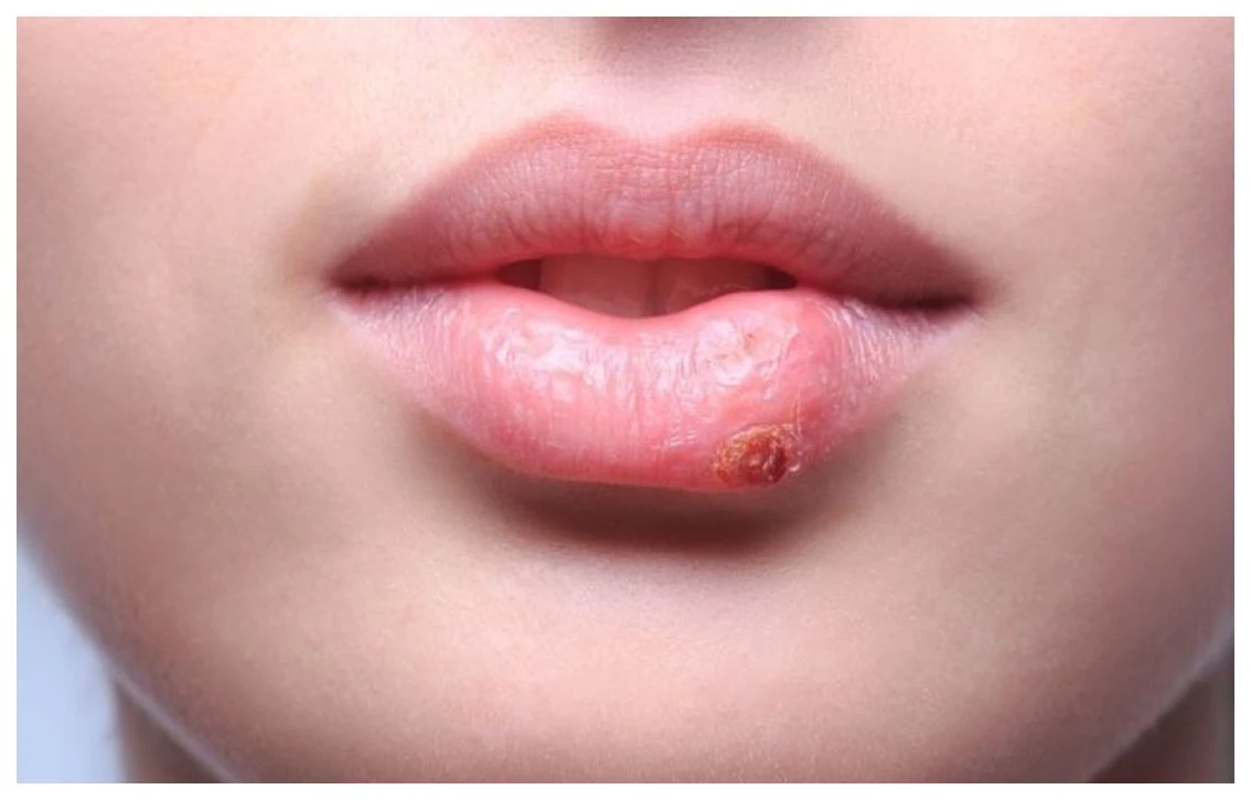 Uçuk neden olur Neden çıkar ve Nasıl Geçer, Uçuğa Ne İyi gelir, Uçuğa Diş Macunu iyi gelir mi?