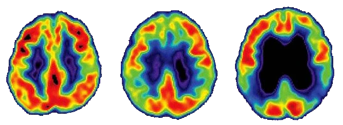 Alzheimer Hastalığı Nedir? Alzheimer Hastalığının İlk Belirtileri Nelerdir?