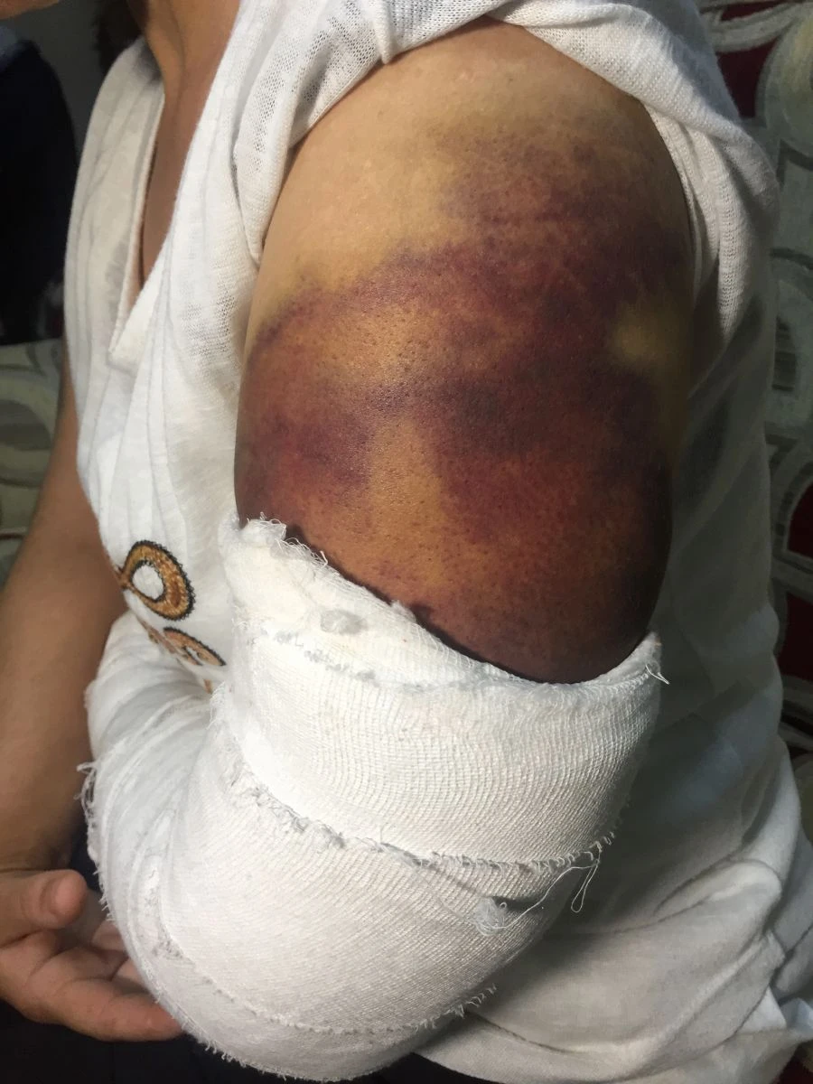 Kocası inşaat demiriyle döverek bu hale getirdi