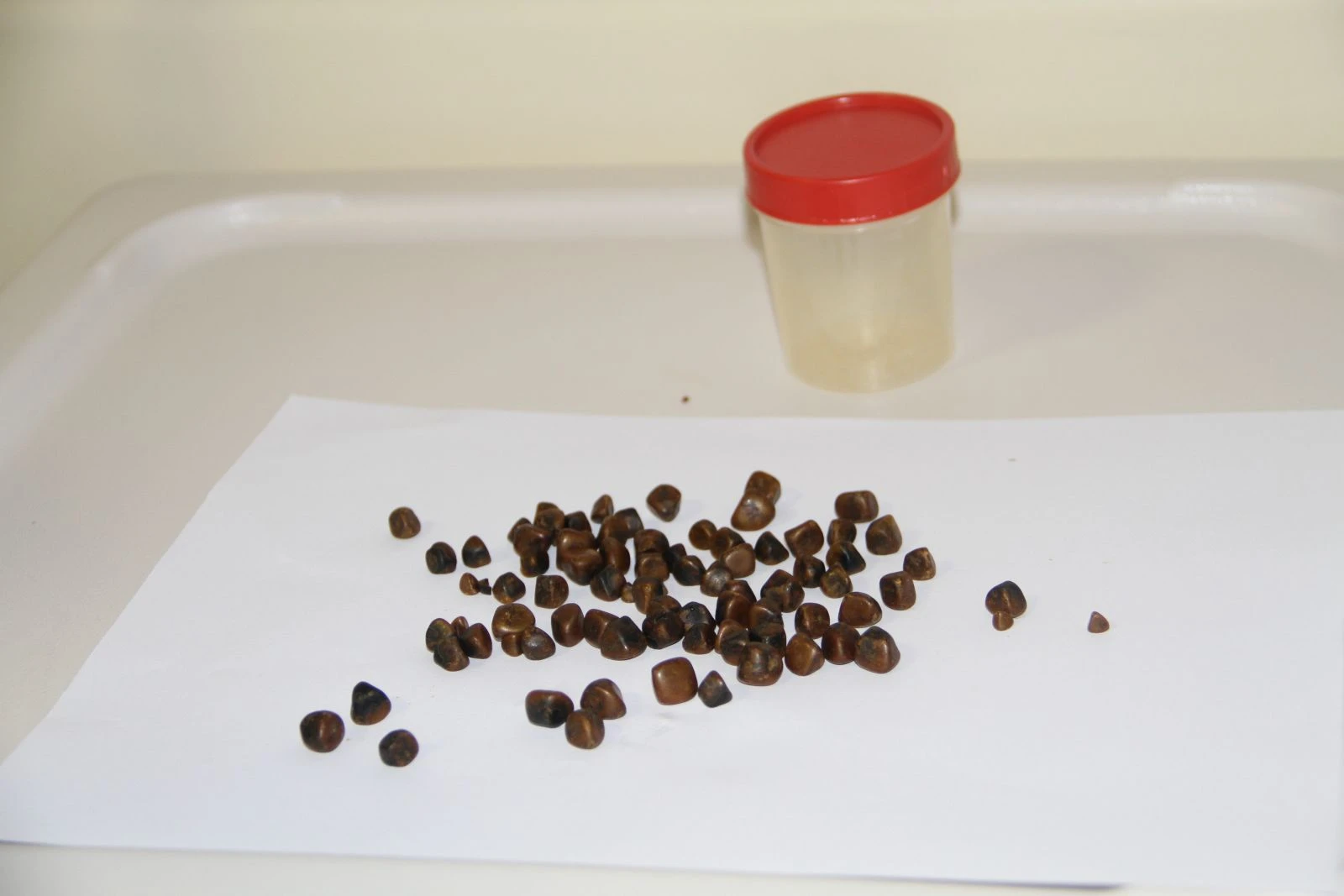 17 yıldır karın ağrısı çeken kadının safra kesesinden 86 parça taş çıkarıldı