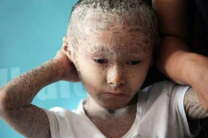 Harlequin Tipi İktiyozis (Palyaço Bebek Hastalığı) Nedir? Neden Olur?