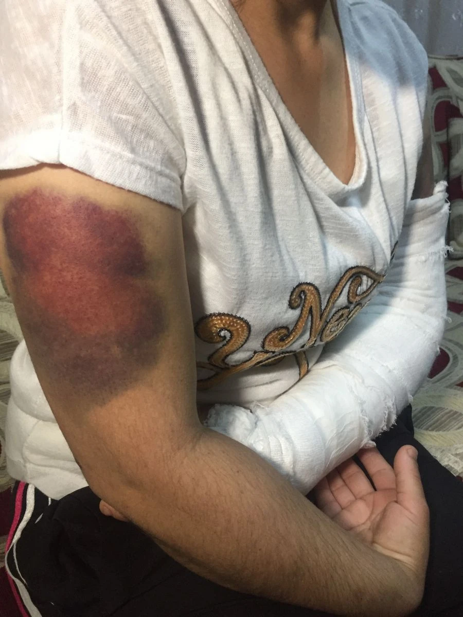 Kocası inşaat demiriyle döverek bu hale getirdi