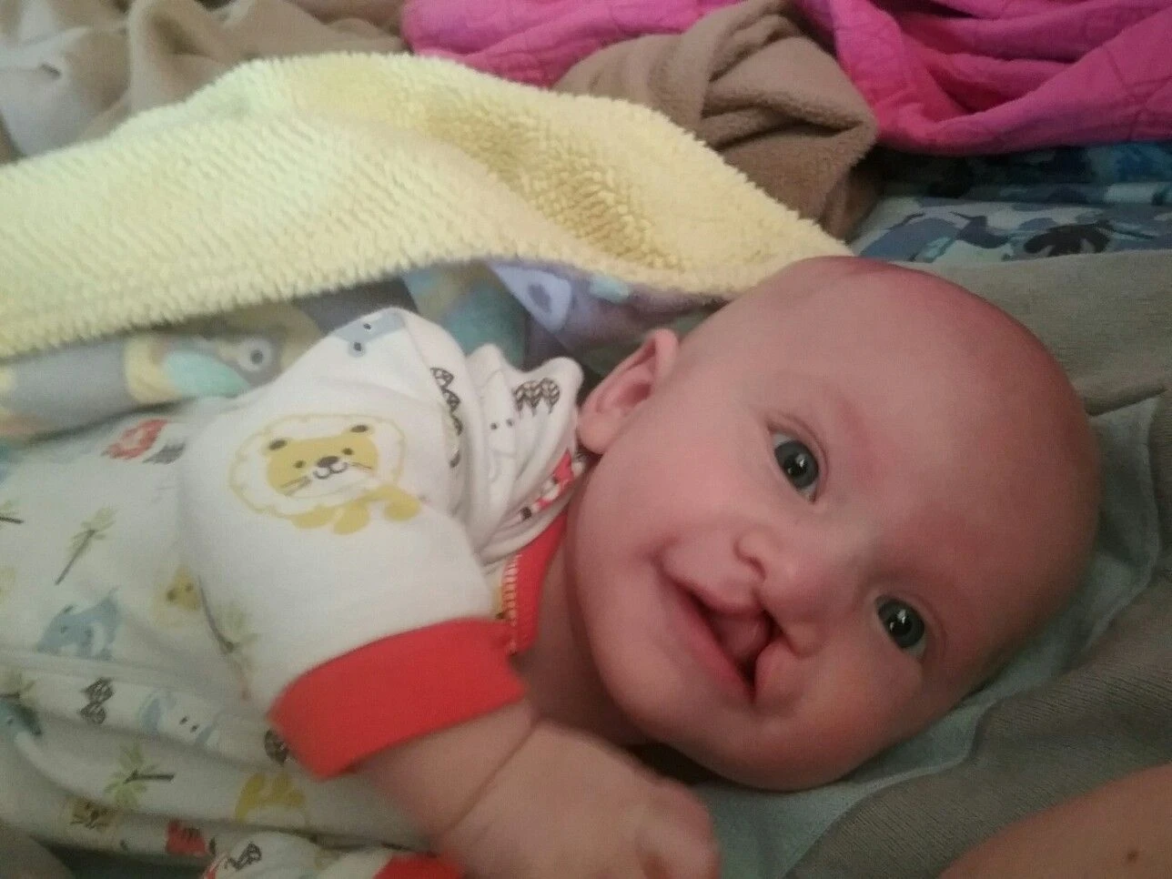 Yarık Damak ve Dudak Bebeklerde Yarık Dudak Ultrasonda Belli Olur mu?