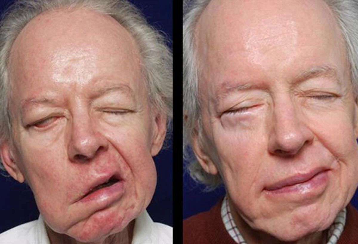 Yüz Felci Nedir? Yüz Felci Neden Olur? Yüz Felci Nasıl Tedavi Edilir?