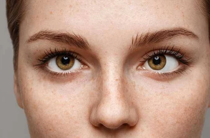 Şaşılık (Strabismus) Nedir?, Şaşılık Tamamen Düzelir mi?