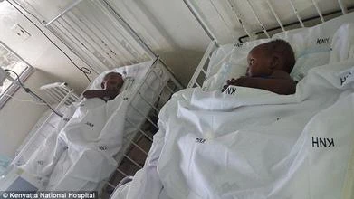 İkizleri ayırmak için 50 cerrah seferber oldu