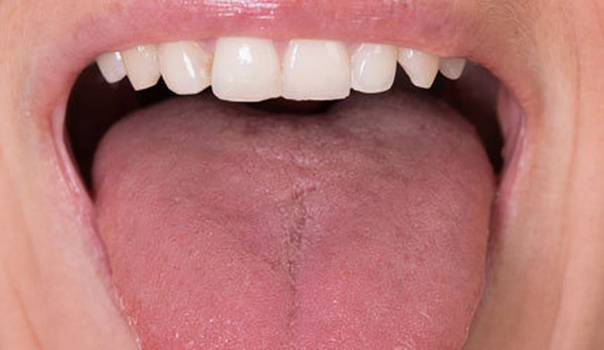 Dil hastalık ve yaraları nedir?/ Dil acıması neden olur?