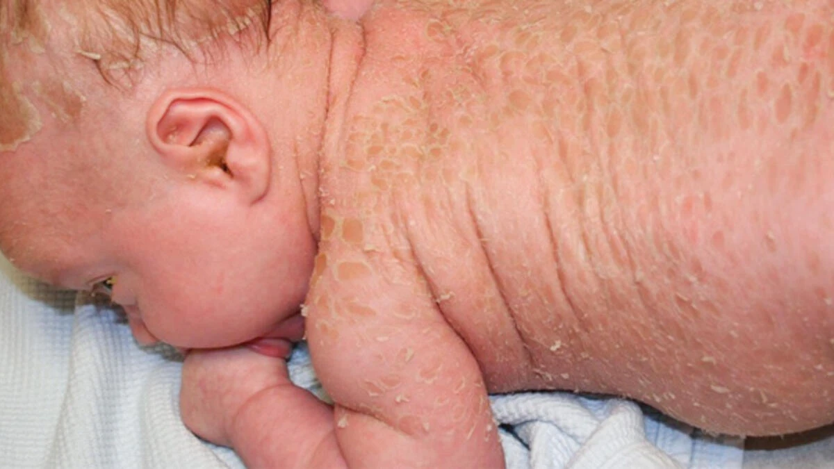 Harlequin Tipi İktiyozis (Palyaço Bebek Hastalığı) Nedir? Neden Olur?