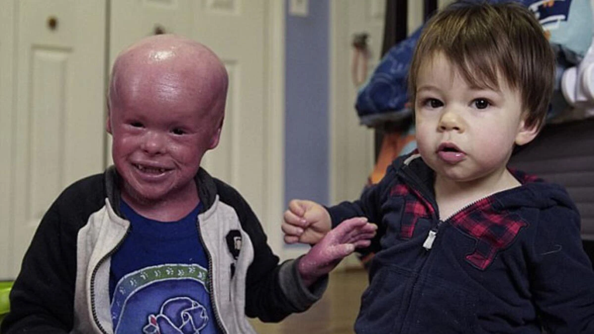 Harlequin Tipi İktiyozis (Palyaço Bebek Hastalığı) Nedir? Neden Olur?