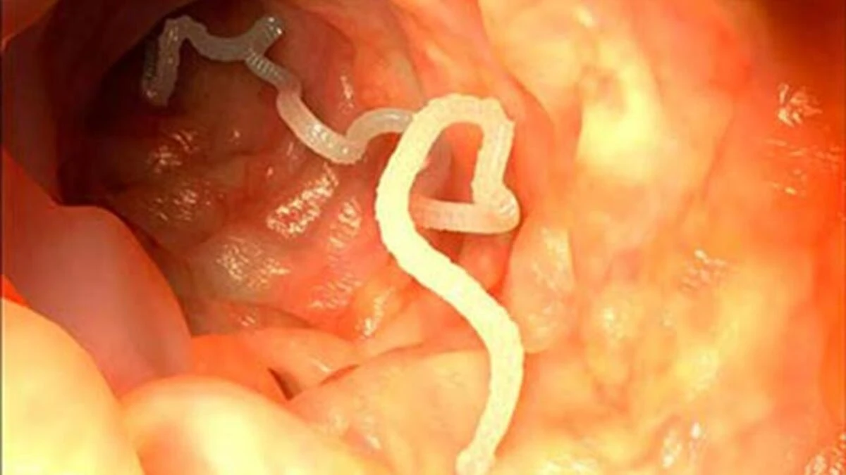 Kancalı Kurt Enfeksiyonu, Bağırsak Kurdu Nasıl Düşürülür?