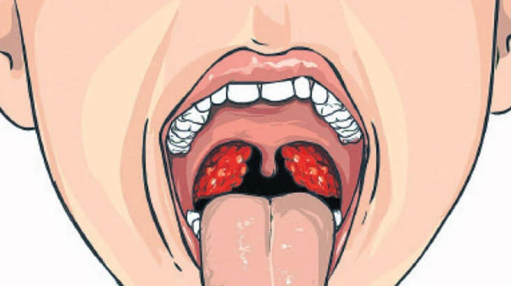 Bademcik Şişmesi Nasıl Geçer Evde? Farenjit - Boğaz İltihabı Nedir?