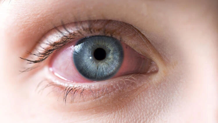 Göz Şişmesi Nasıl Geçer? Göz Şişkinliğine Ne İyi Gelir?