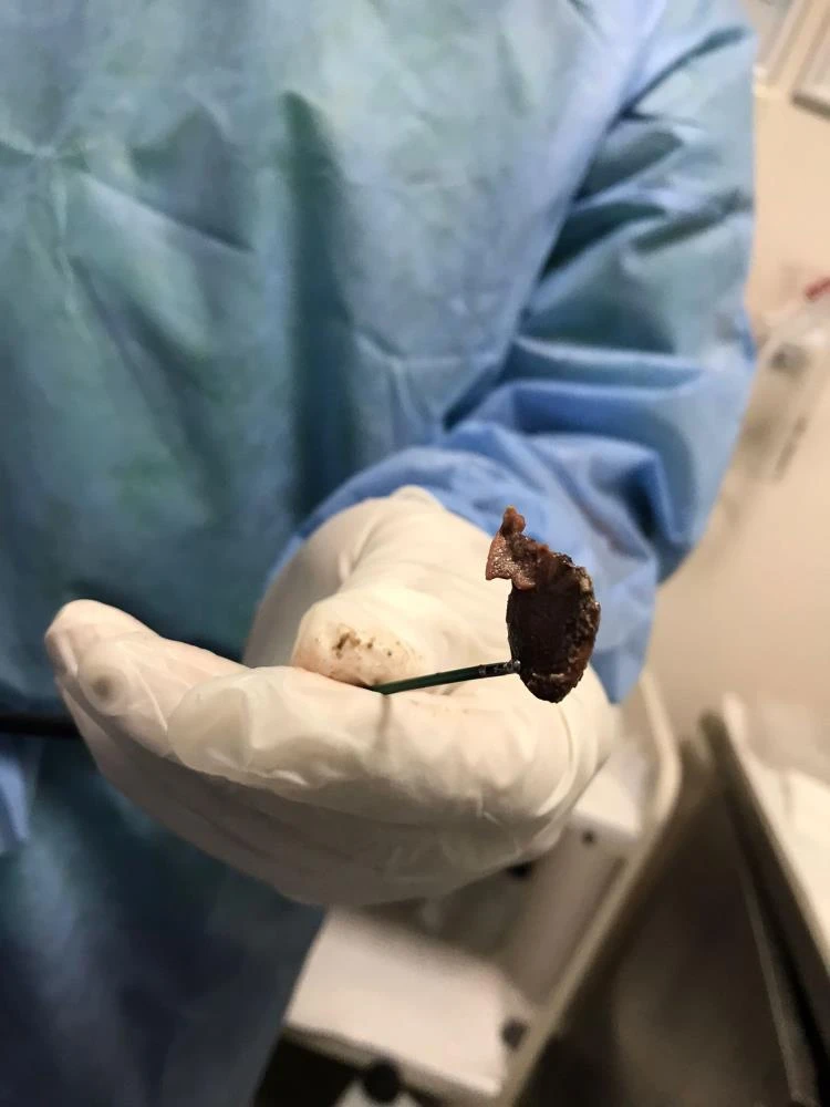 Doktorları şaşkına çevirdi: Akciğerinden çekirdek çıktı