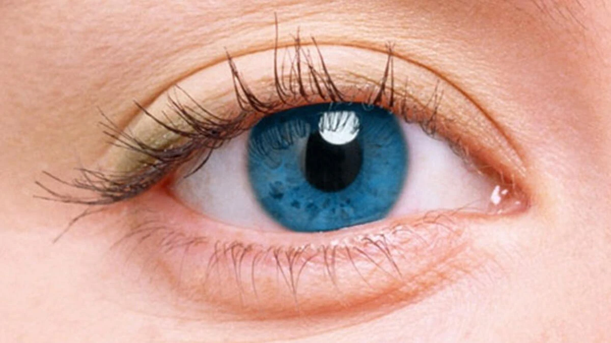 İris İltihabı (İritis) Göz Romatizması Nedir Neden Olur?