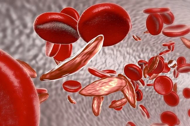 Hemoglobinopati Nedir?