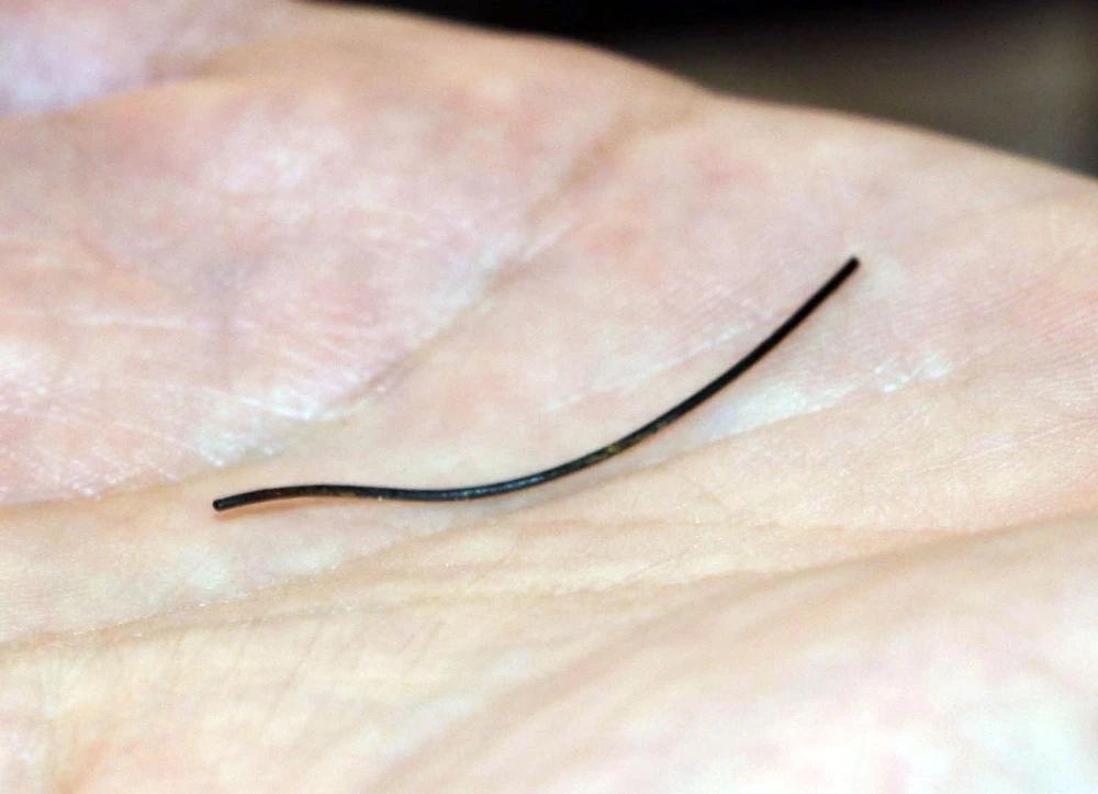 Petek bal yedi, midesinden 10 santim tel çıktı