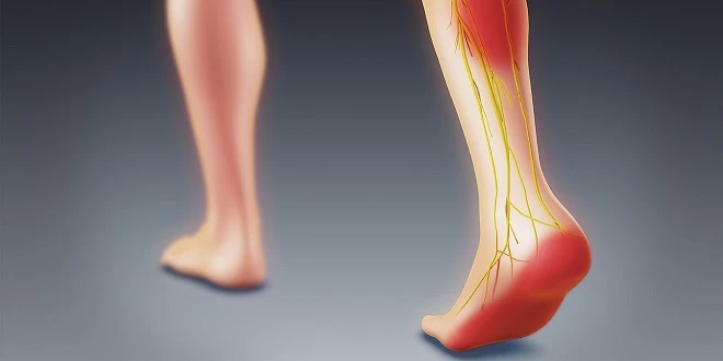 Siyatik ağrısı nedir? Siyatik hastalığı nasıl tedavi edilir?