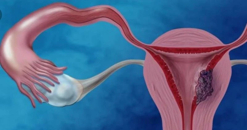 Histerektomi Nedir? Rahim Alınması Ameliyatı