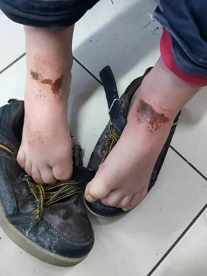 Kartopu oynarken vücutlarında yanık oluşan 2 öğrencinin tedavisi sürüyor