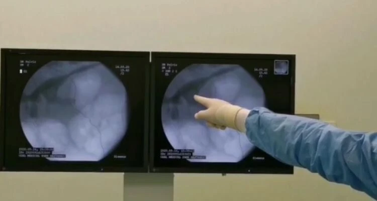 Tek böbrekli hasta, yapılan operasyonla dünya literatüründe 84’üncü vaka oldu