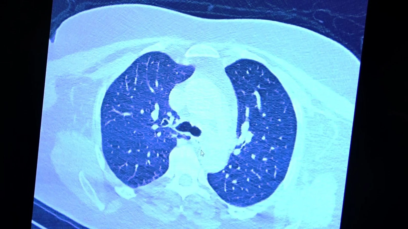 İlaç kullanan korona hastaları ile kullanmayanlar arasındaki inanılmaz fark