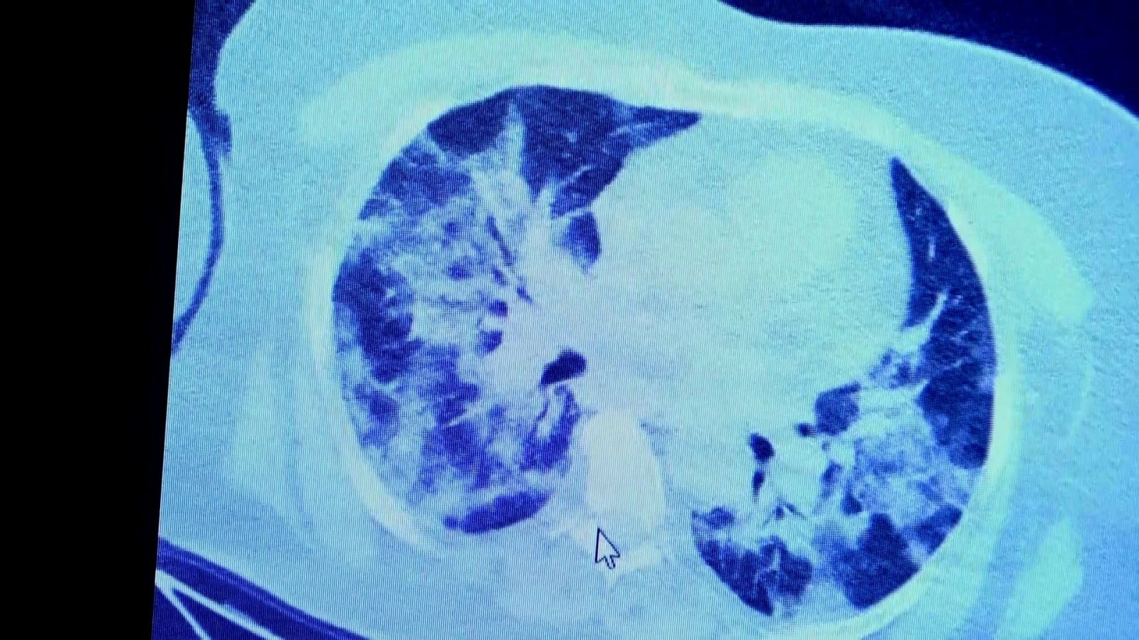 İlaç kullanan korona hastaları ile kullanmayanlar arasındaki inanılmaz fark