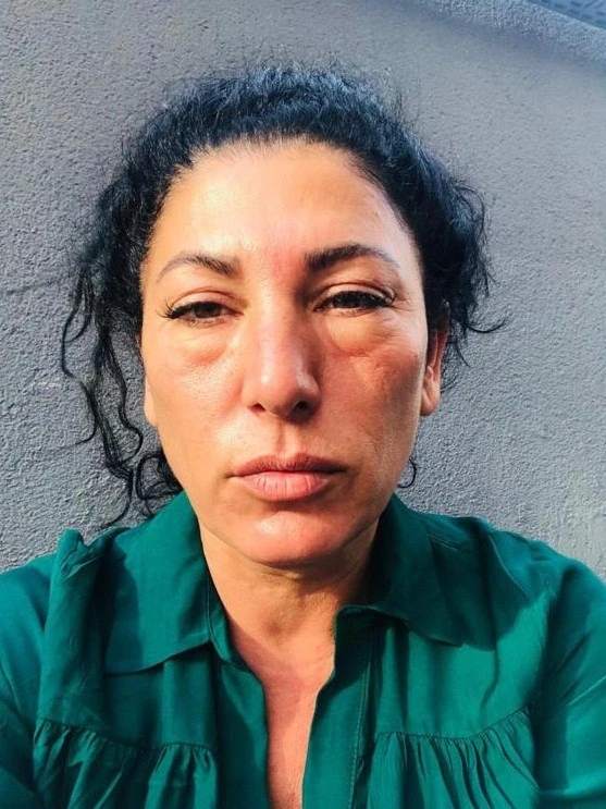 Gözaltı ışık dolgusu yaptırdı, hayatı karardı