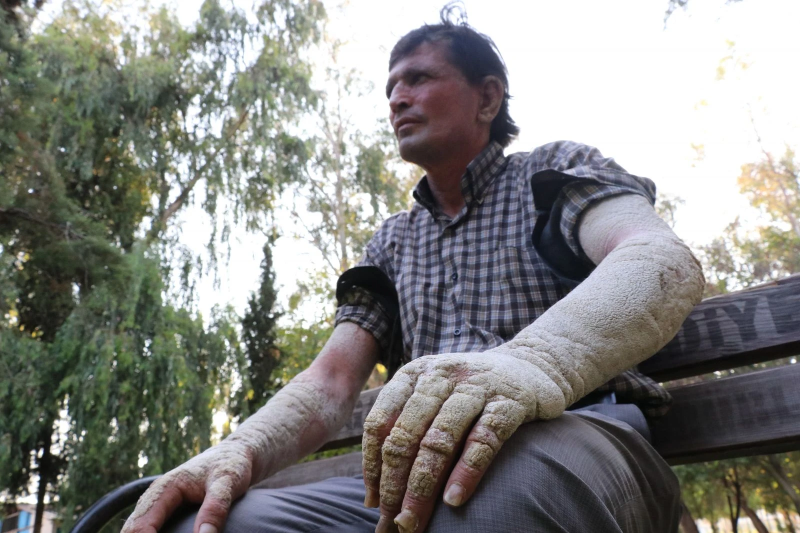Hastalığı değil, insanların kendini görünce korkup uzaklaşması kahrediyor