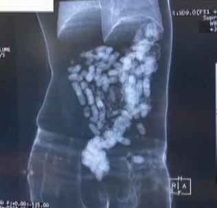 Sindirim sistemlerinde eroin taşıyan kuryeler yakalandı