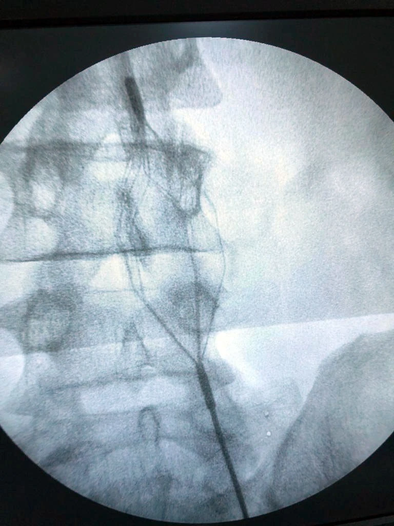 Yerli ve milli tıbbi cihaz ile büyük başarı