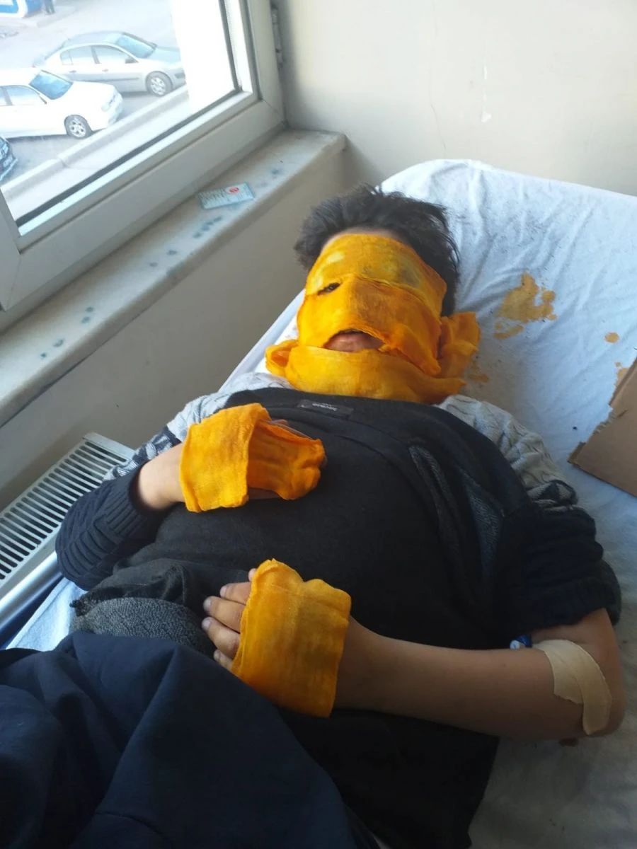 Sprey boya bomba gibi patladı: Ölümden döndü