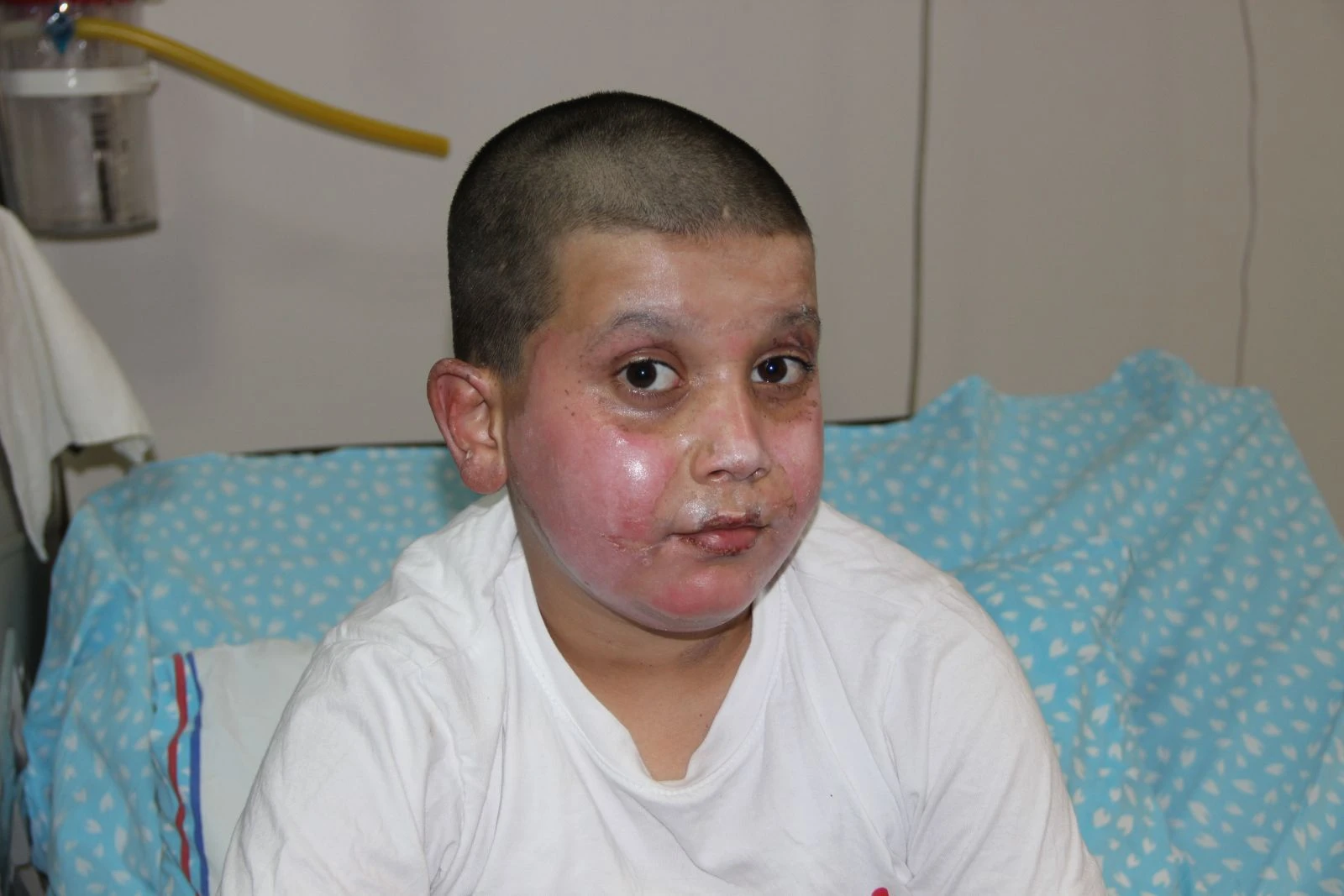 Sprey boya bomba gibi patladı: Ölümden döndü