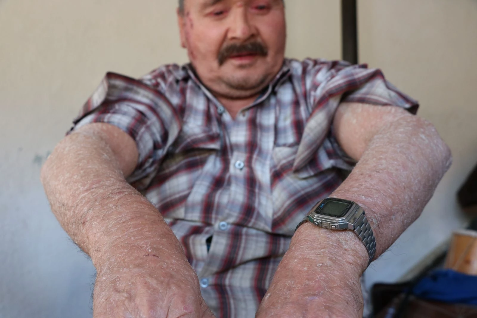 'Balık pulu' hastalığı vatandaşların kabusu oldu