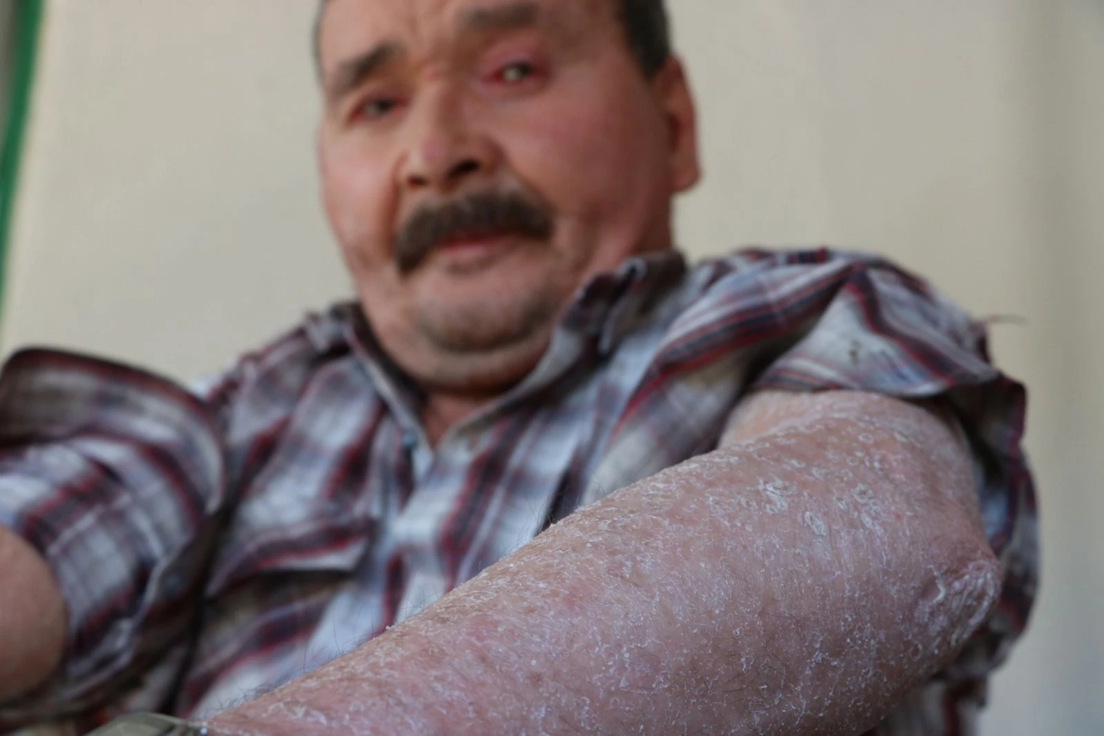 'Balık pulu' hastalığı vatandaşların kabusu oldu