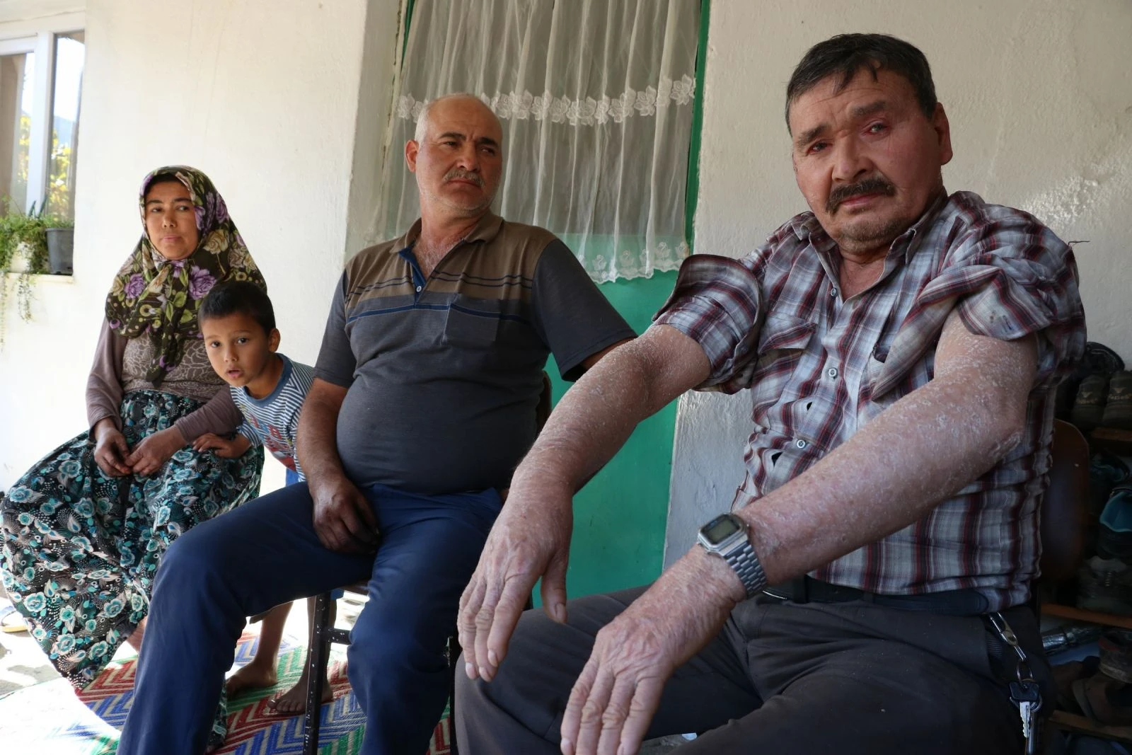 'Balık pulu' hastalığı vatandaşların kabusu oldu