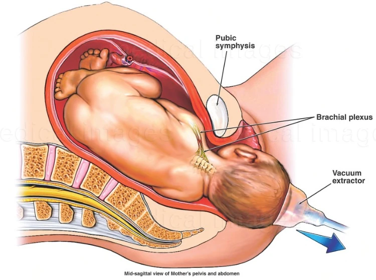 Doğumsal Brakiyal Pleksus Hasarı Neden Olur?