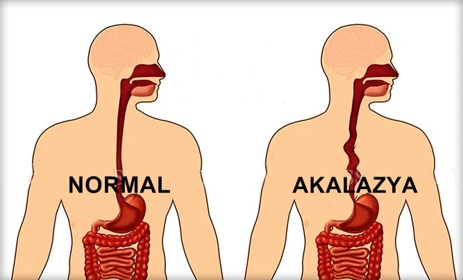 Akalazya Neden Olur?