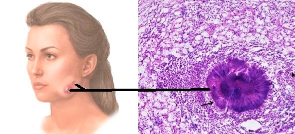 Aktinomikoz ne demek? Aktinomikoz neden olur? Aktinomiçes enfeksiyonu nedir? Aktinomikoz nasıl bulaşır?