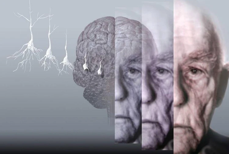 Alzheimer (Alzaymır) Hastalığı Nedir İlk Belirtileri Nelerdir?