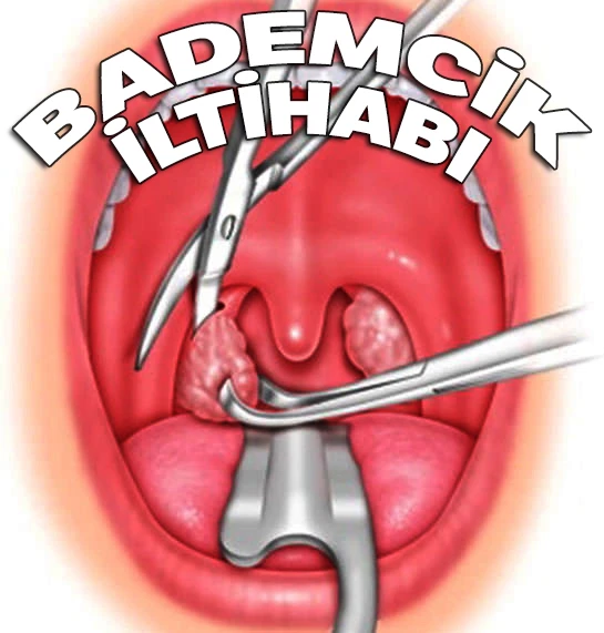 Kriptik Tonsillit, Bademcik İltihabı Nedir Nasıl Geçer