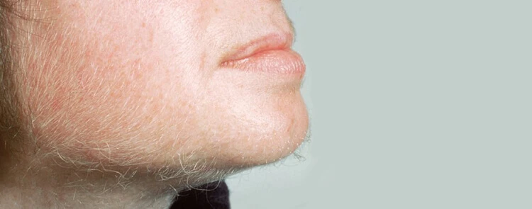 Polikistik Over Sendromu (PCOS) ve Hirşutizm (Kadınlarda Kıllanma)