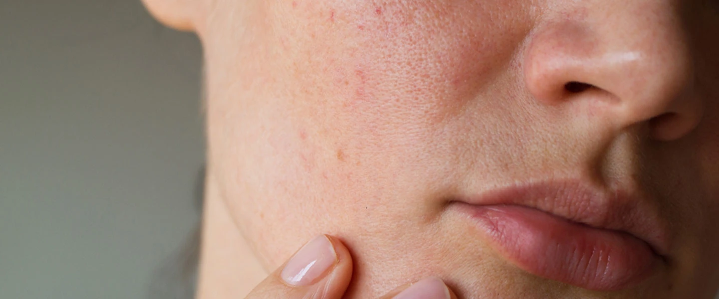 Deride renk değişimi neden olur? Ciltte kararma neden olur? Deride renk koyulaşması