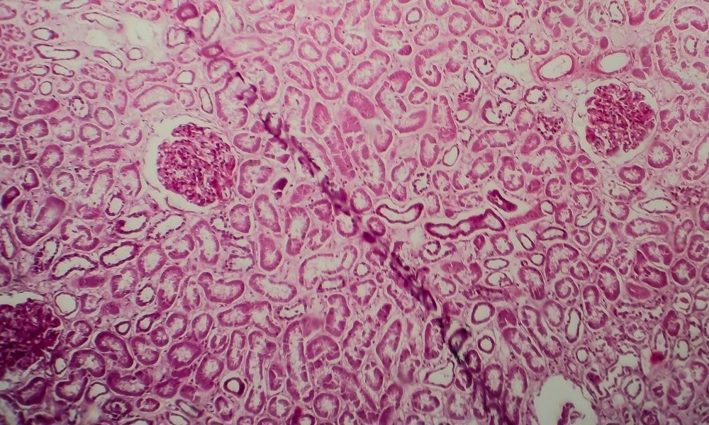 Primer Biliyer Siroz (PBS) Ne demektir? Primer biliyer siroz belirtileri nelerdir?
