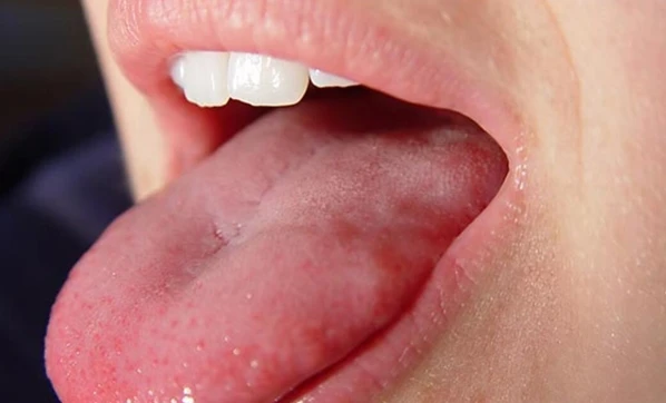 Ağız kanseri nedir? Ağız kanseri olduğumu nasıl anlarım?