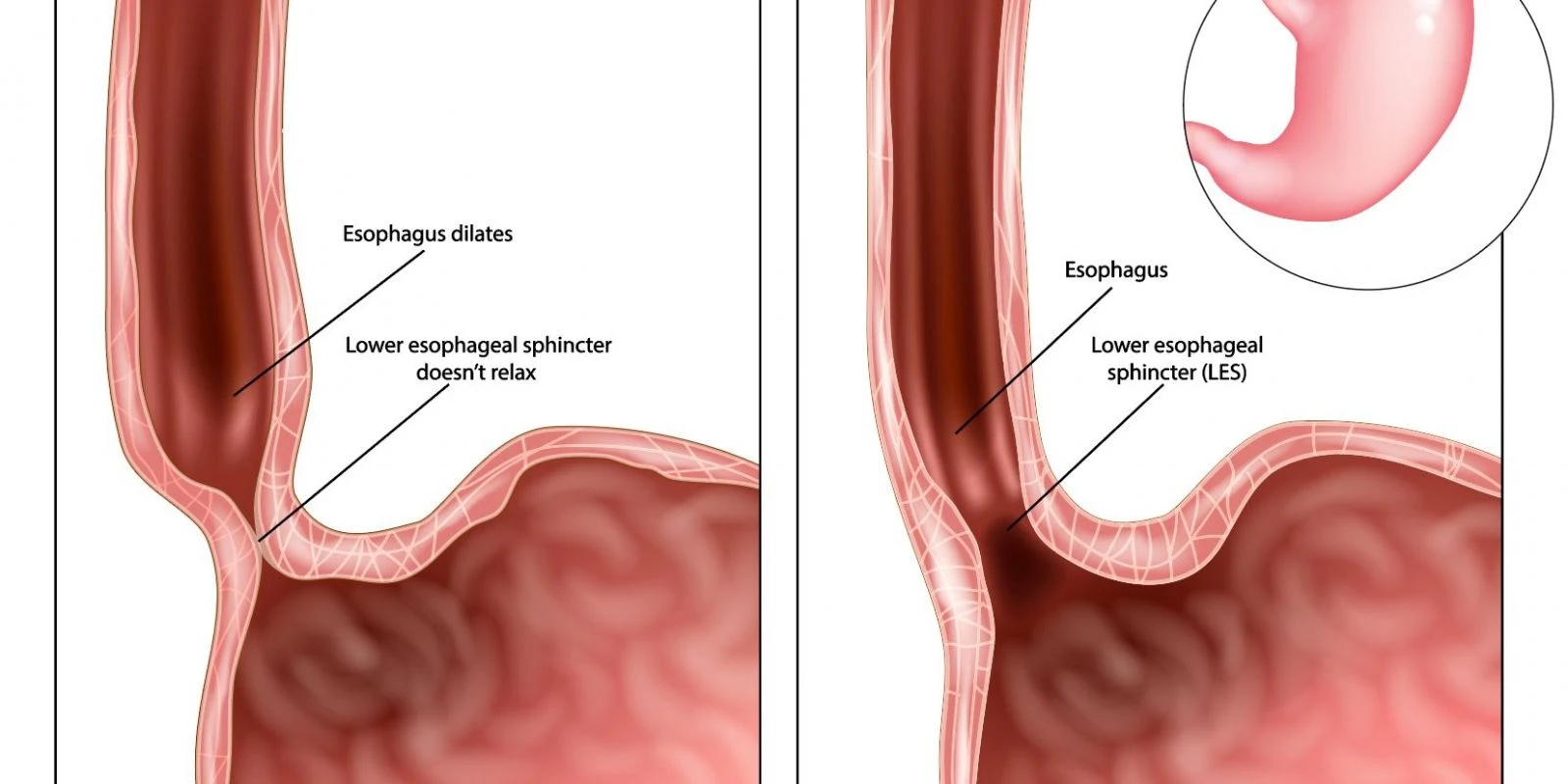 Akalazya tanısı nasıl konulur?