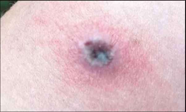 ABD'de yeni salgın alarmı! Hepsi aynı bölgede ve yayılıyor