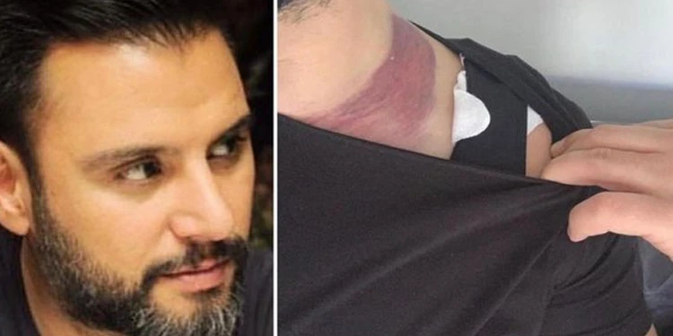 Göbeğinden yağ aldıran Alişan'dan 2 milyonluk estetik davası