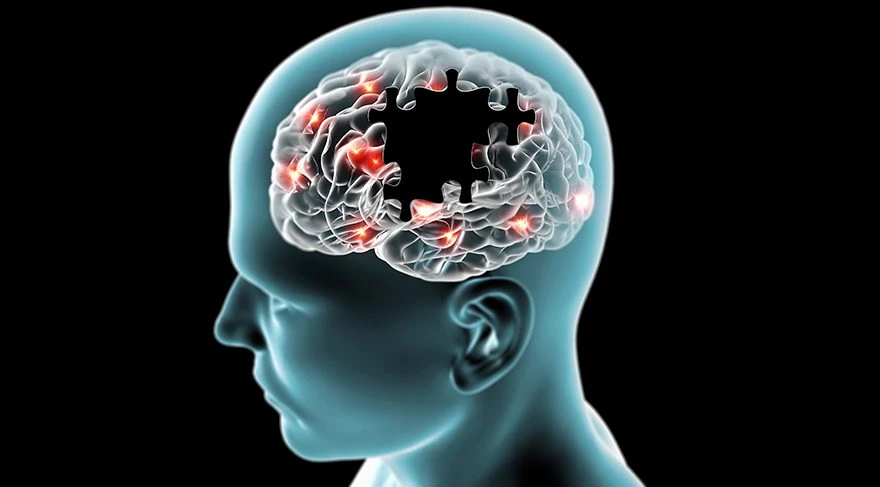 Alzheimer (Alzaymır) Hastalığı Nedir İlk Belirtileri Nelerdir?