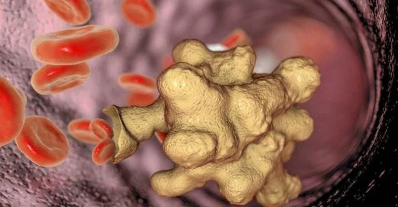 Amipli Dizanteri Nedir? Amipli Dizanteri İshal Kaç Gün Sürer?